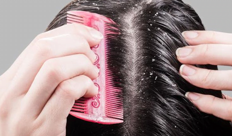 Cara Menghilangkan Ketombe Tips Praktis untuk Rambut Bebas Ketombe